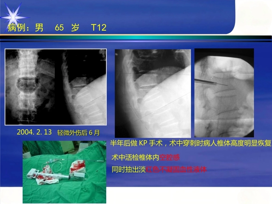 胸腰椎骨 折_第4页