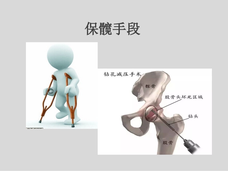 冲击波疗法治疗股骨头坏死(1)_第10页