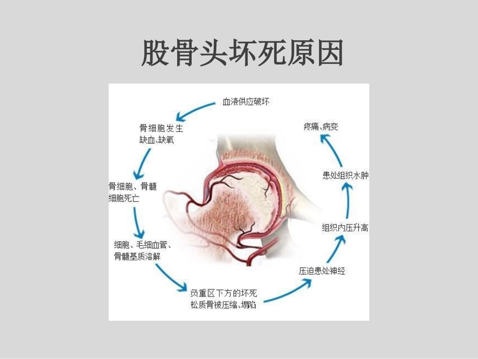 冲击波疗法治疗股骨头坏死(1)_第4页