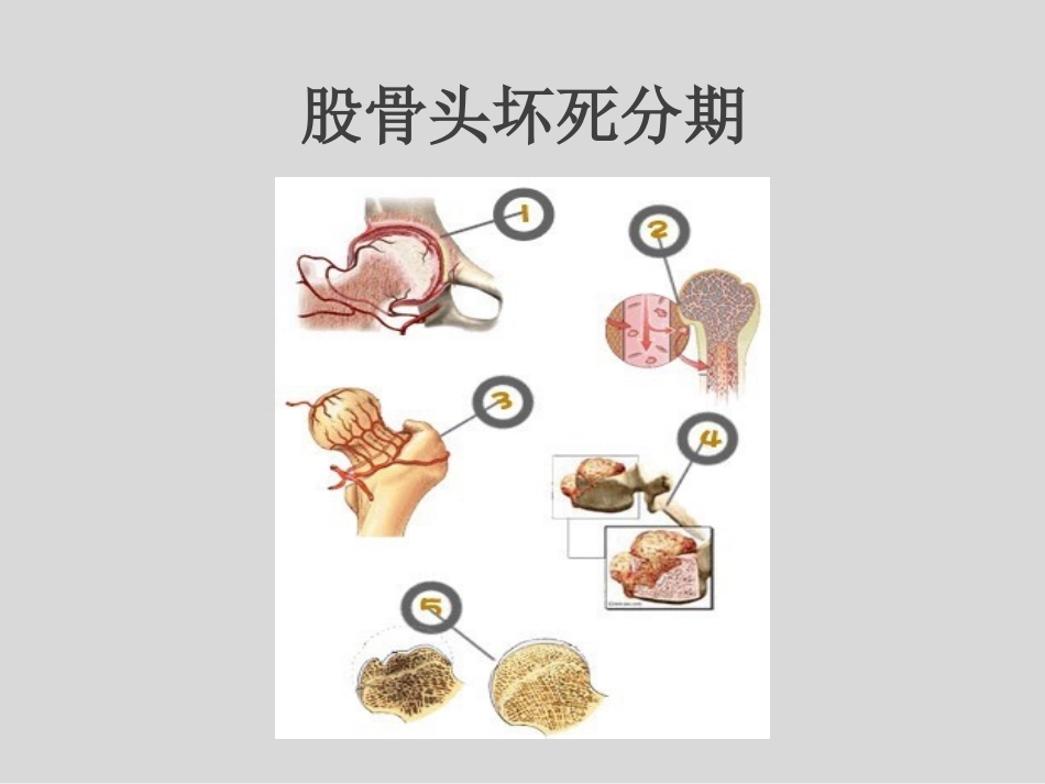 冲击波疗法治疗股骨头坏死(1)_第8页