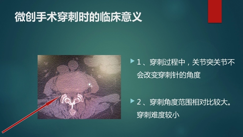 椎间孔的解剖 (1)_第14页