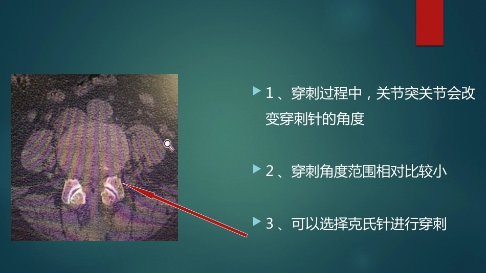 椎间孔的解剖 (1)_第15页