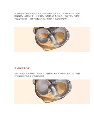 盘状半月板2