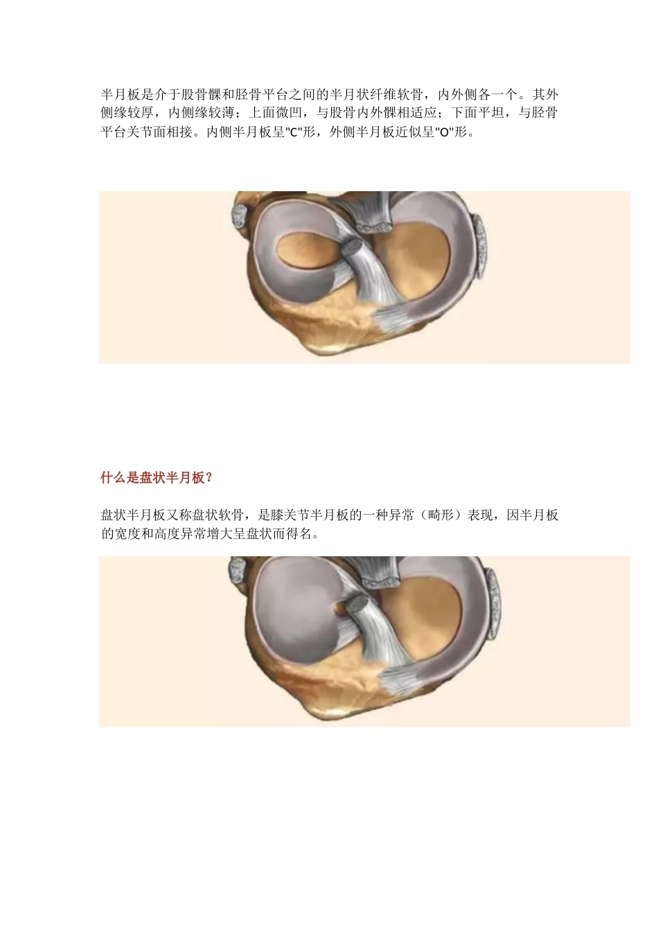 盘状半月板2_第1页