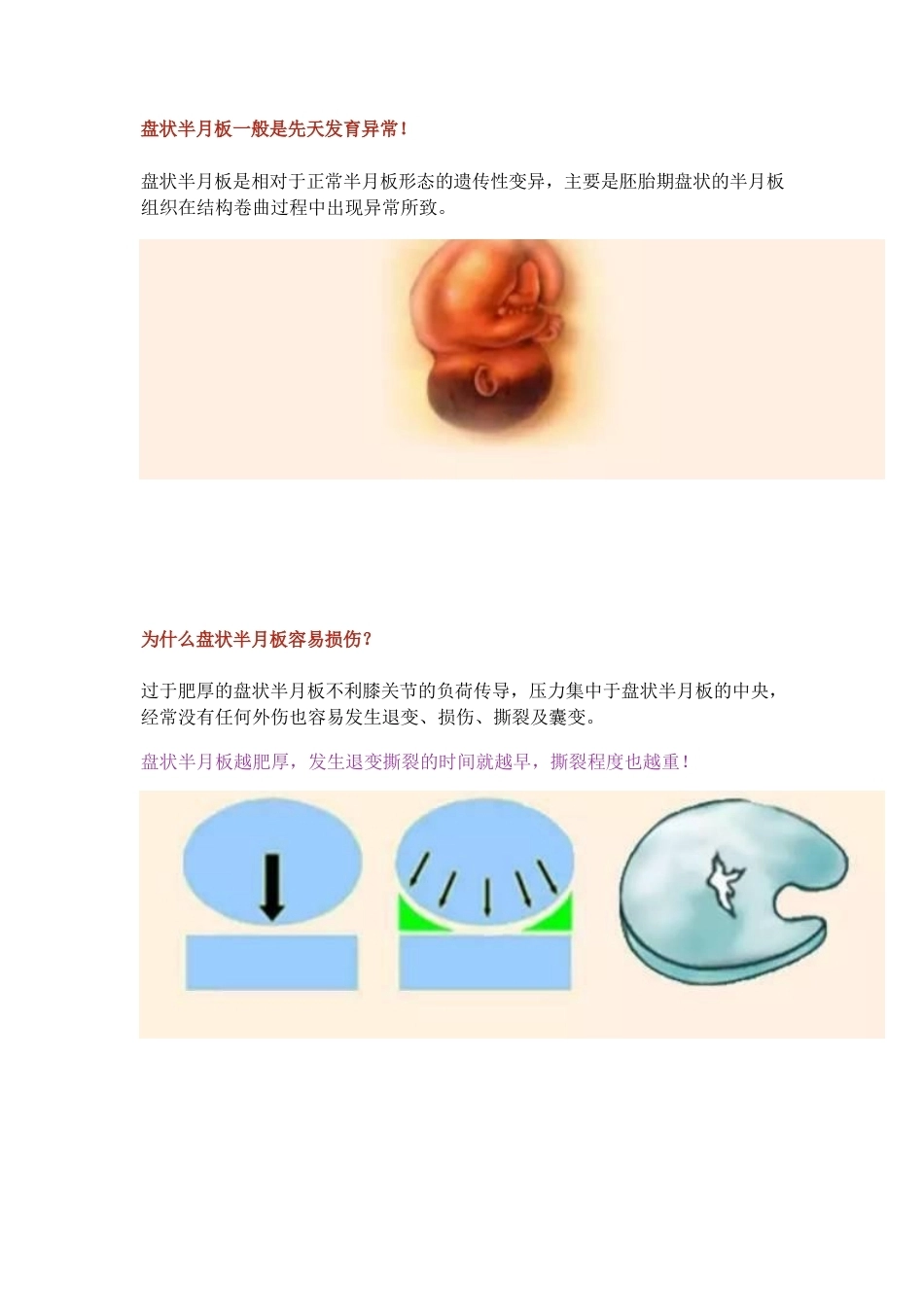 盘状半月板2_第3页
