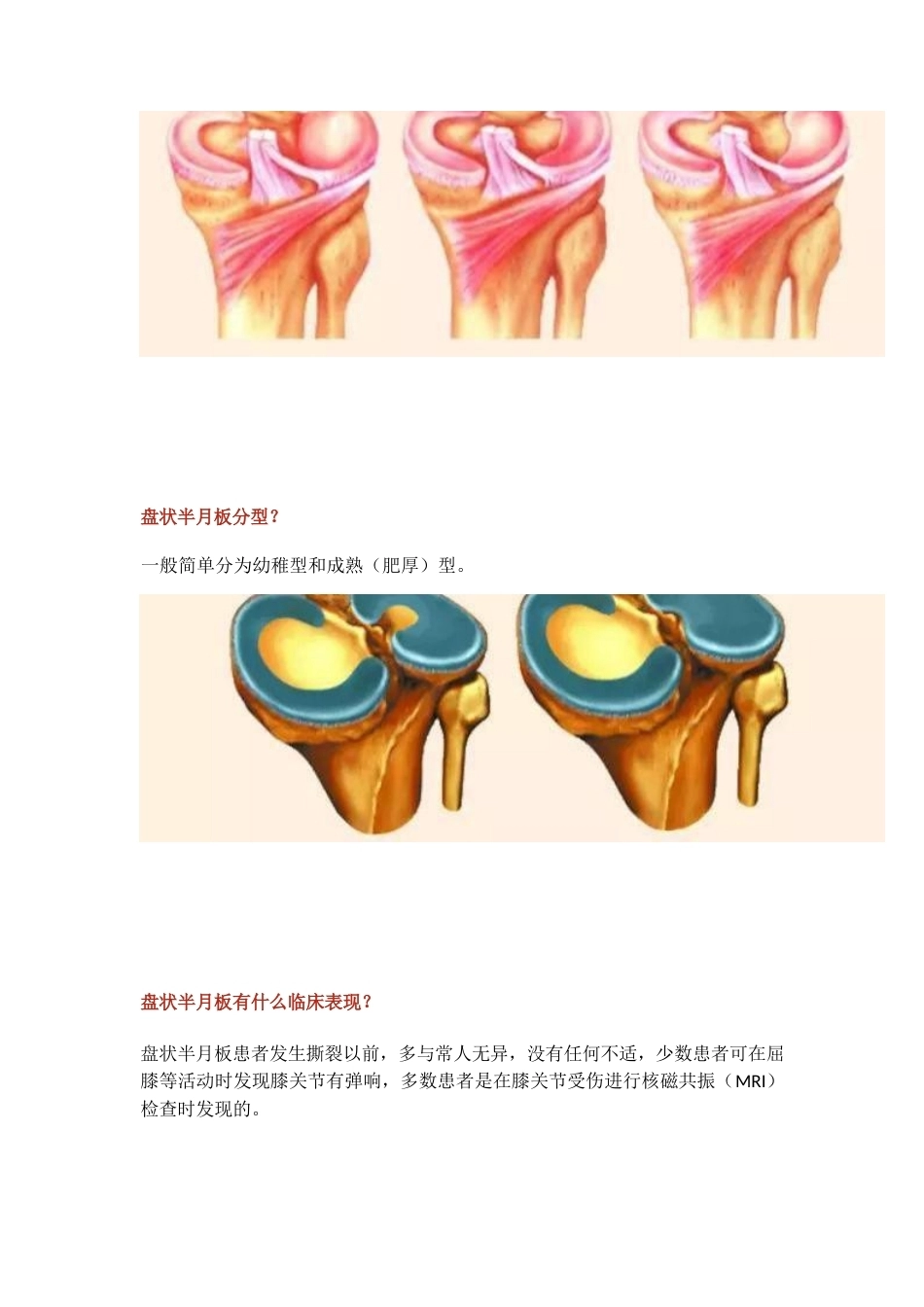 盘状半月板2_第5页