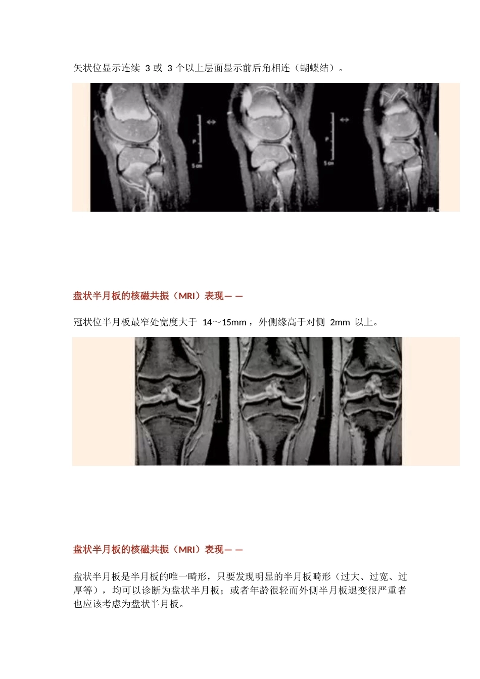 盘状半月板2_第7页