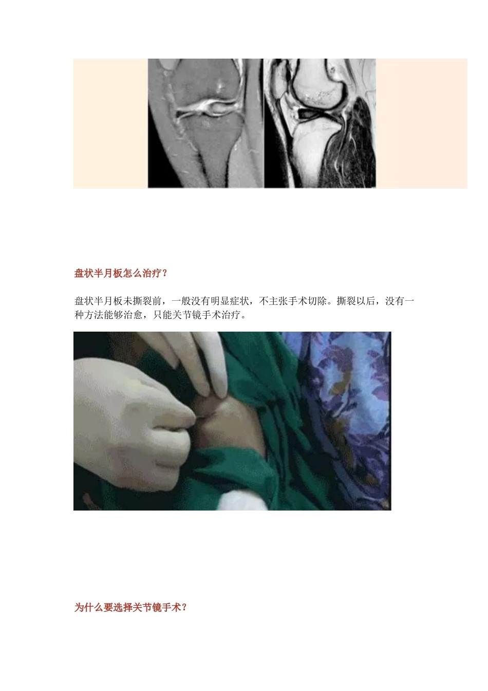 盘状半月板2_第8页