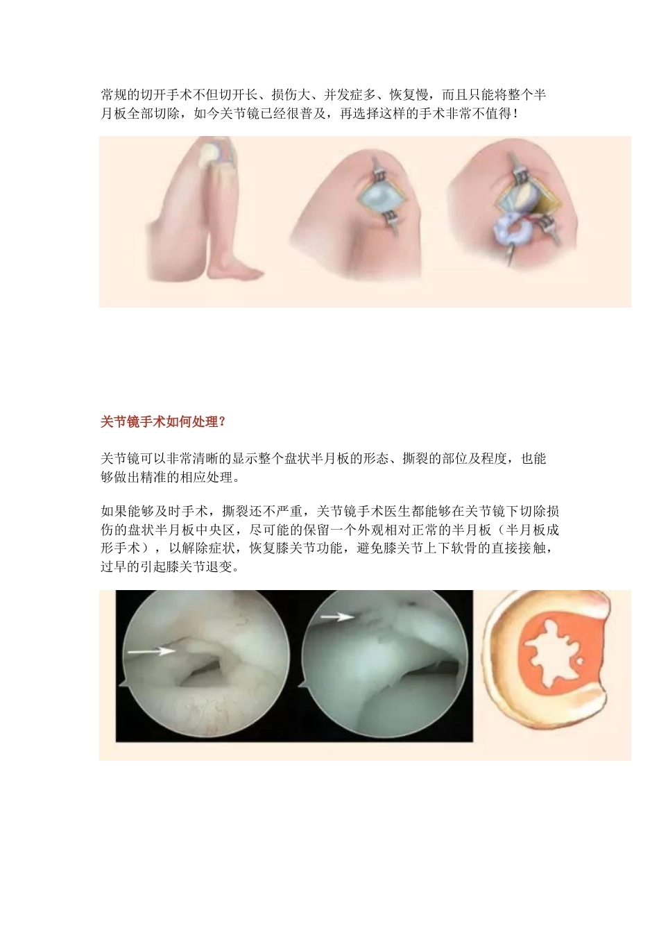 盘状半月板2_第9页