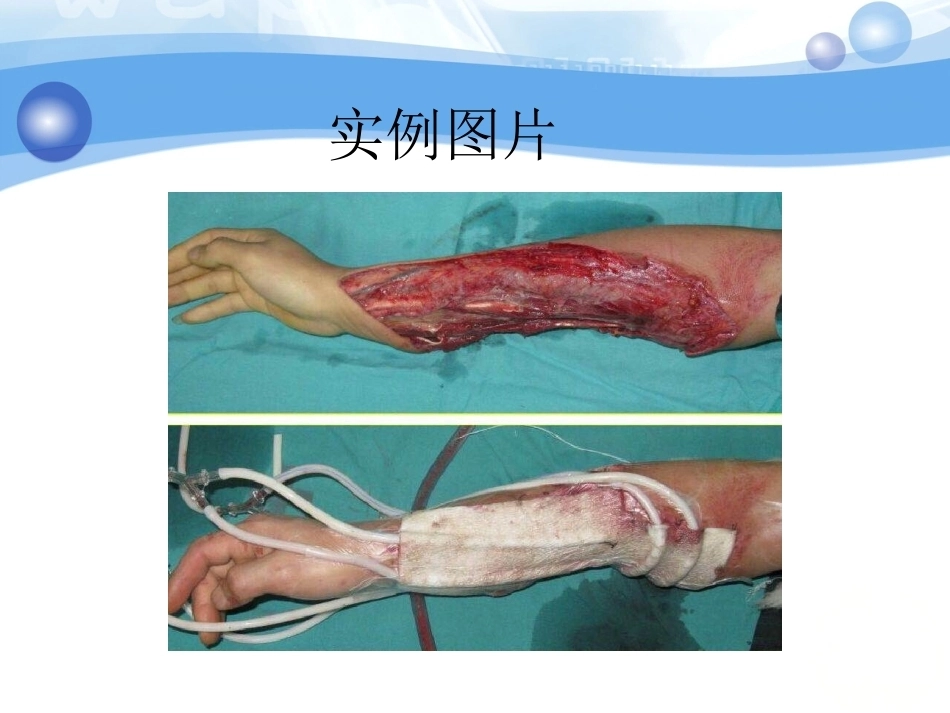 负压吸引在骨科中的应用(2)_第4页