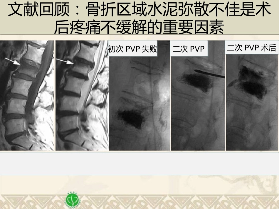 精准椎体成形术2_第10页