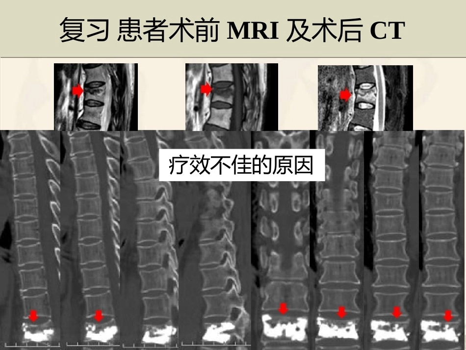 精准椎体成形术2_第11页