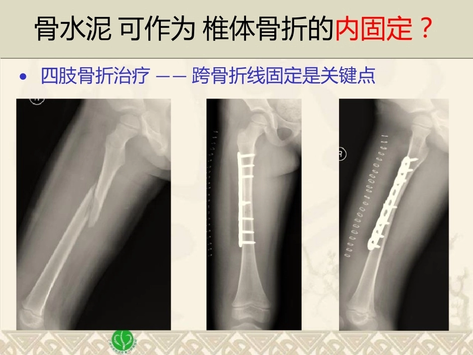 精准椎体成形术2_第12页