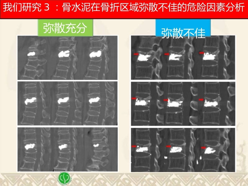 精准椎体成形术2_第15页