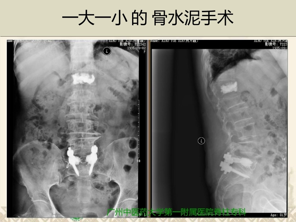 精准椎体成形术2_第2页