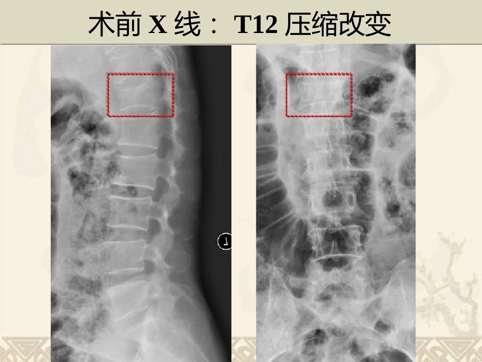 精准椎体成形术2_第6页