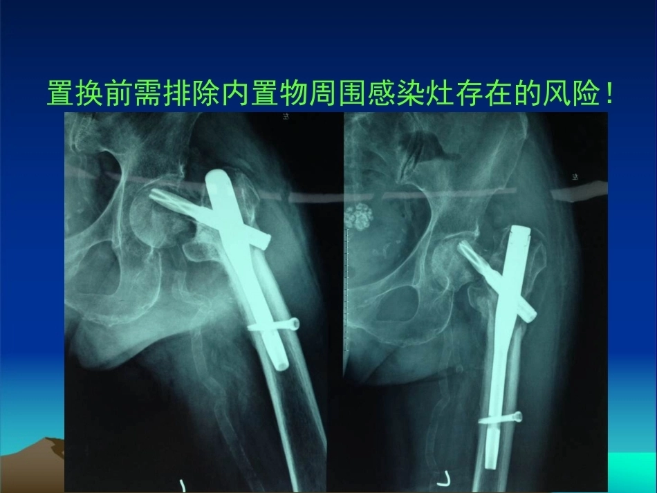 复杂性髋关节THA系列二 ( 2)_第10页