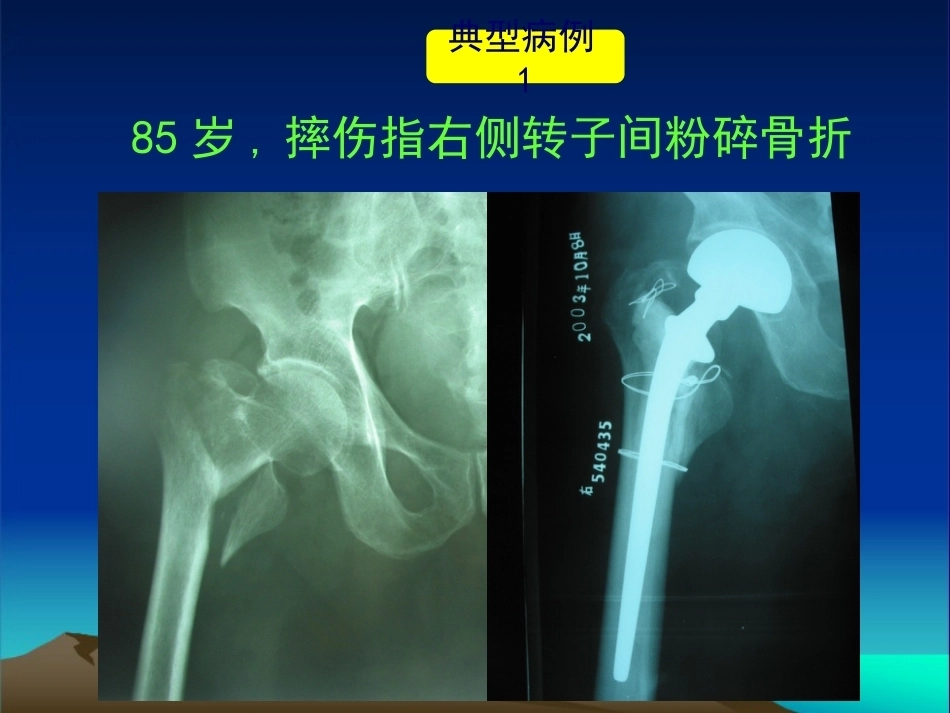 复杂性髋关节THA系列二 ( 2)_第11页