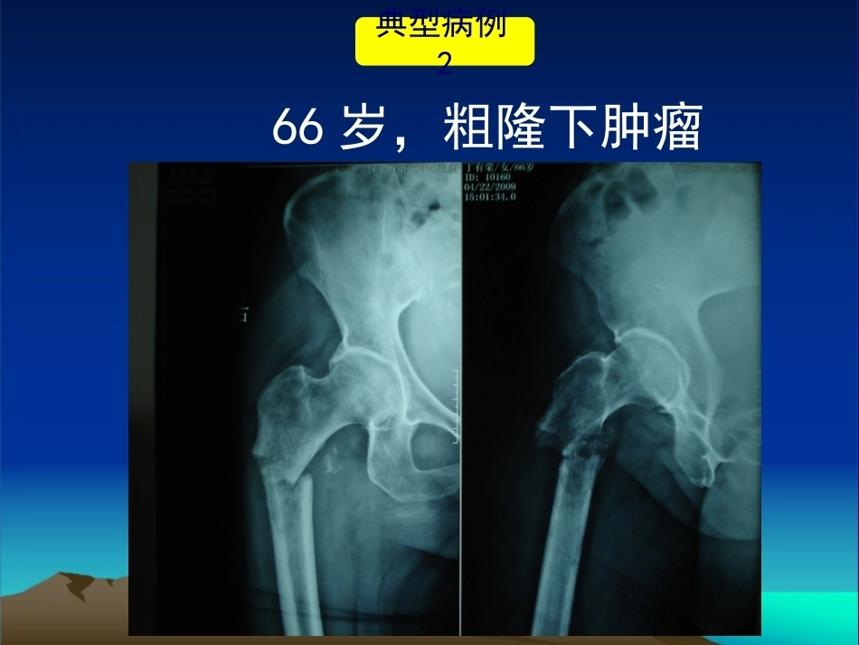 复杂性髋关节THA系列二 ( 2)_第12页