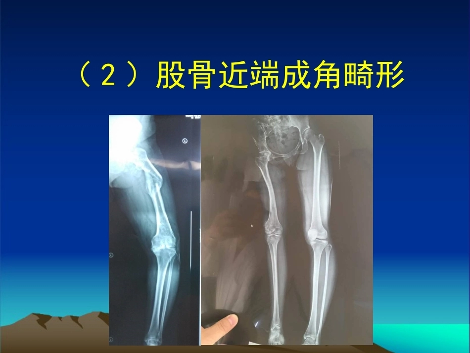 复杂性髋关节THA系列二 ( 2)_第14页