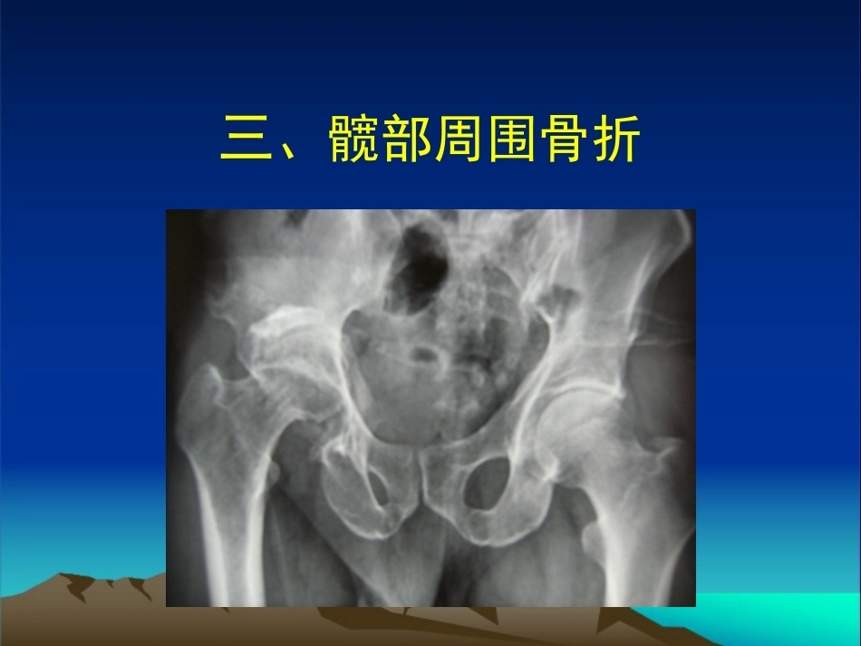 复杂性髋关节THA系列二 ( 2)_第2页