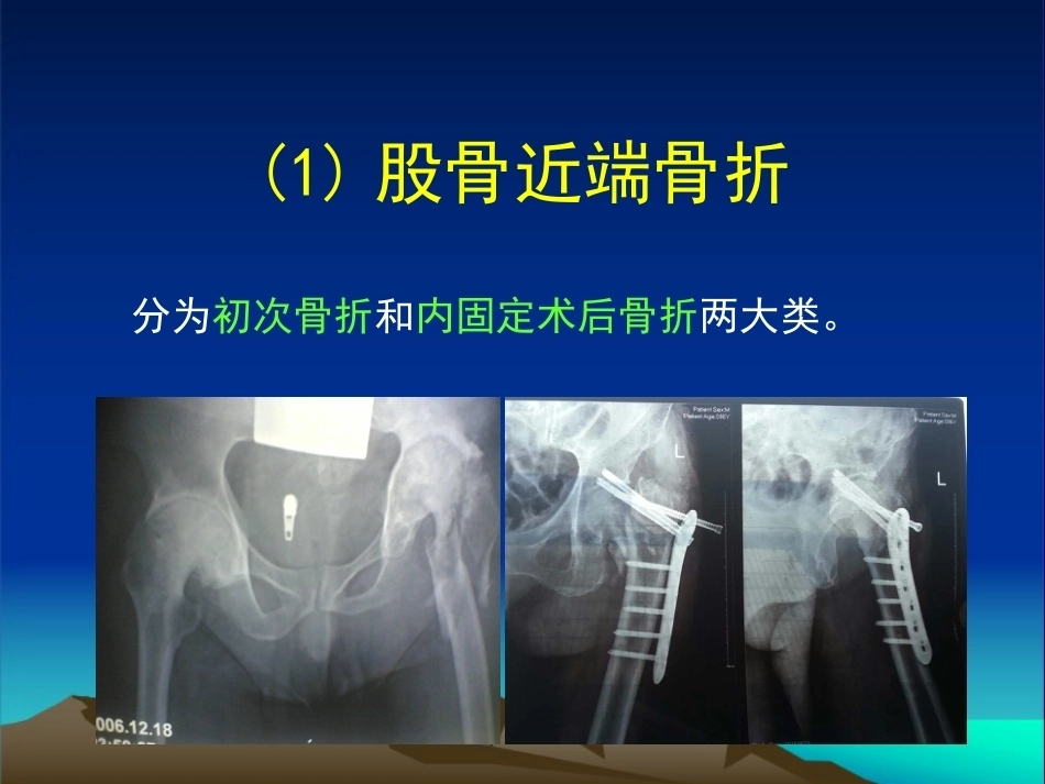 复杂性髋关节THA系列二 ( 2)_第3页
