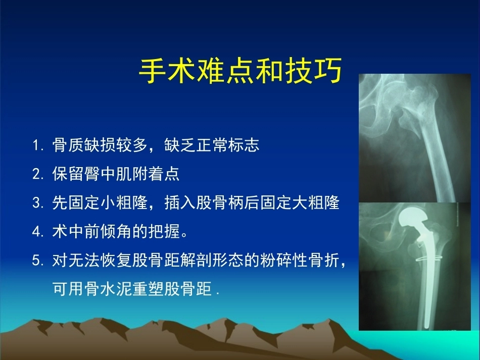 复杂性髋关节THA系列二 ( 2)_第8页