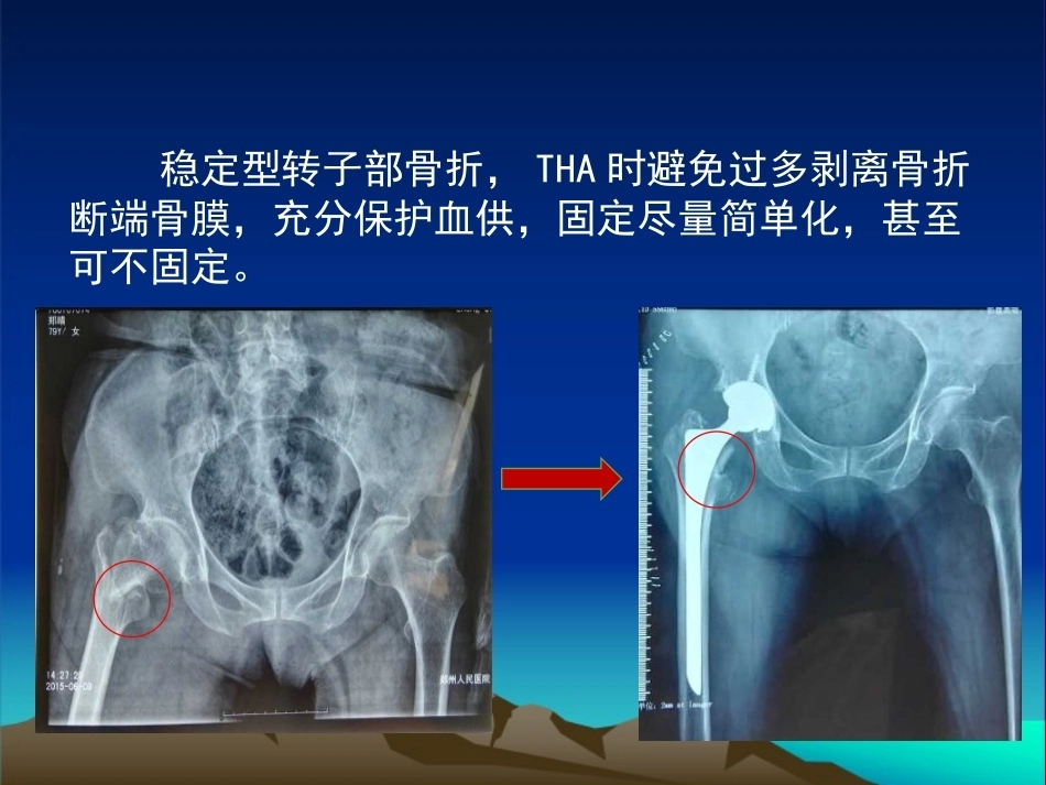 复杂性髋关节THA系列二 ( 2)_第9页