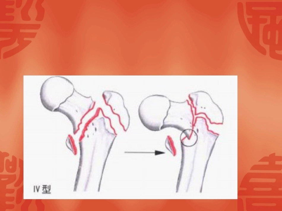 2.骨折常用分型_第10页