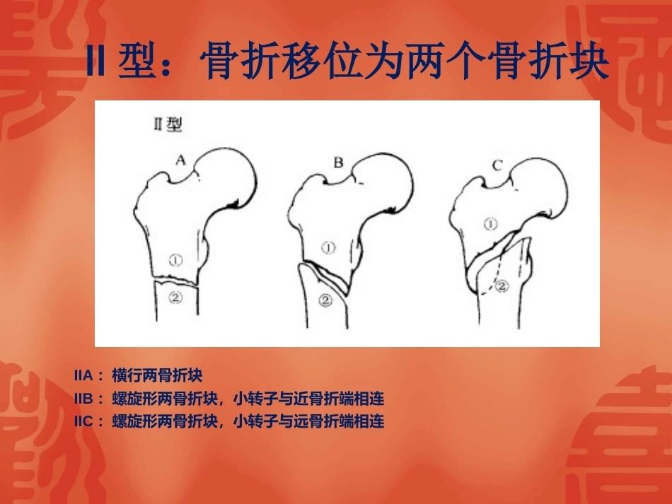 2.骨折常用分型_第14页