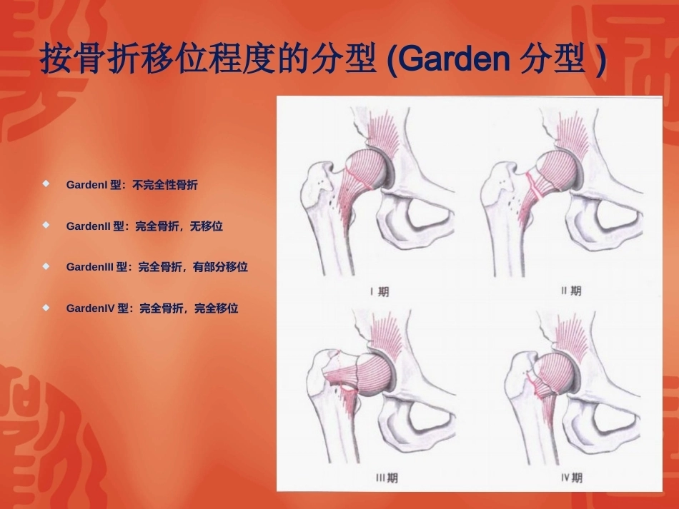 2.骨折常用分型_第5页