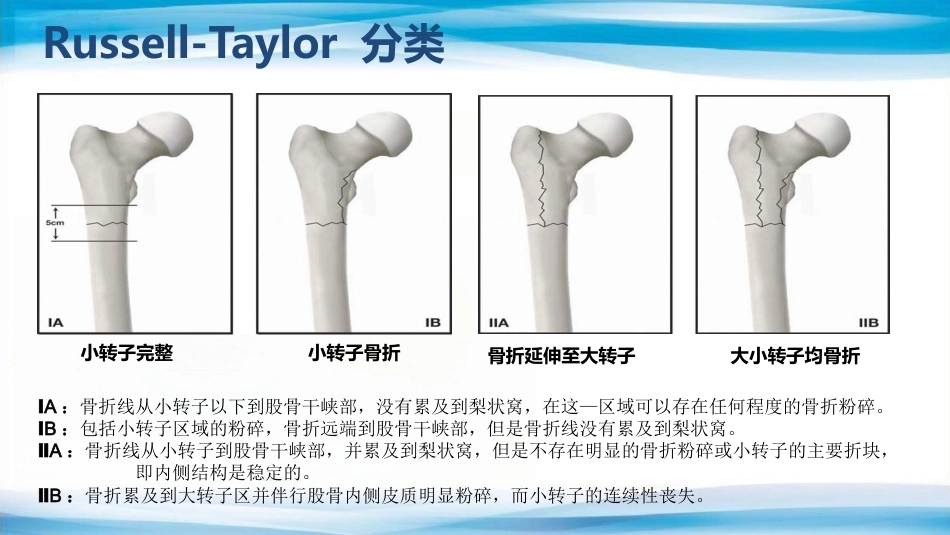转子间骨折(2)_第10页