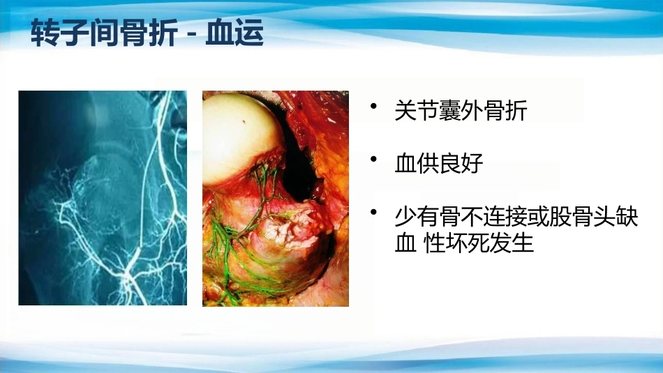 转子间骨折(2)_第3页