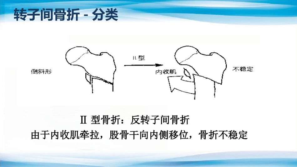 转子间骨折(2)_第7页