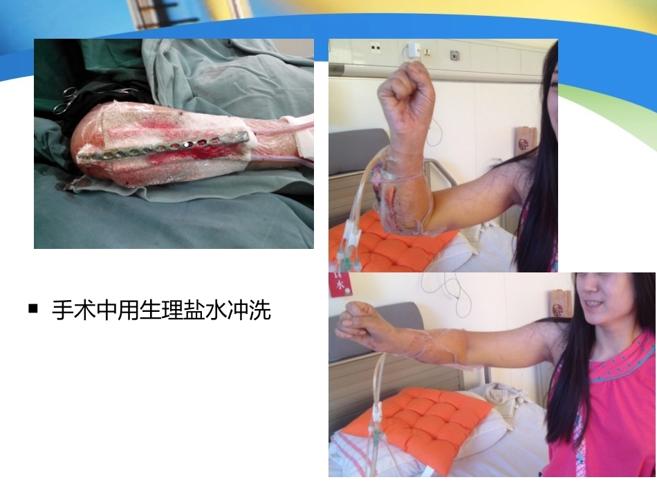 上肢外伤手术技术与技巧(2)_第14页