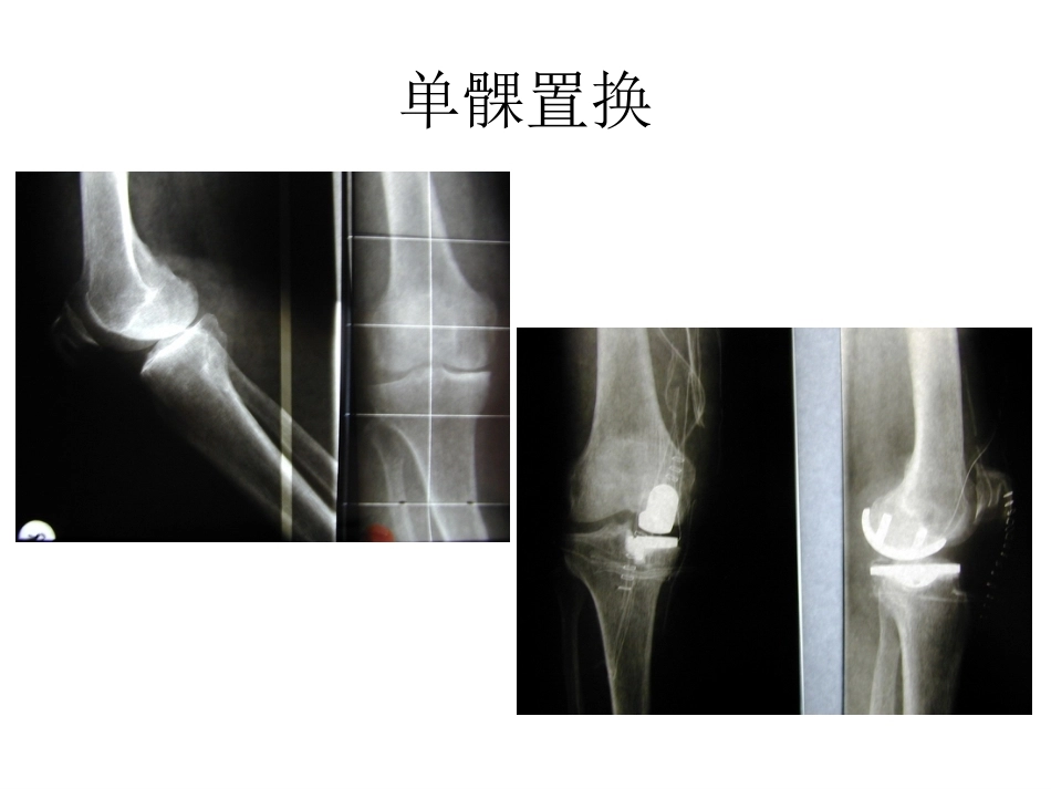 膝关节单髁置换（2）_第3页