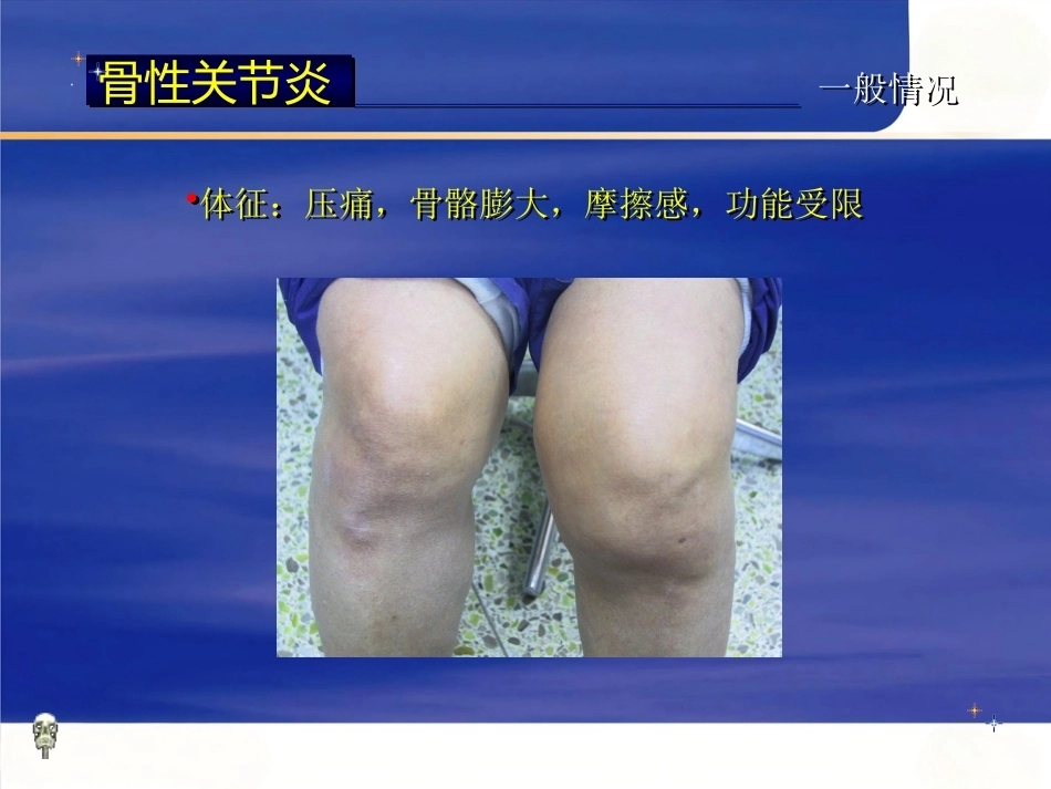 膝关节骨性关节炎的分级治疗2_第10页