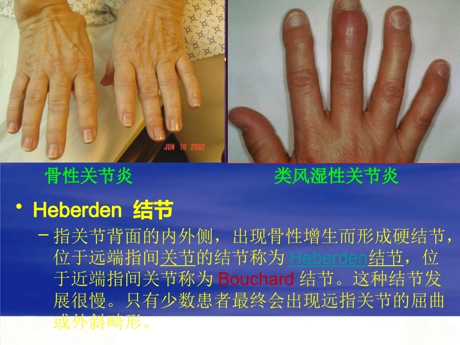 膝关节骨性关节炎的分级治疗2_第11页