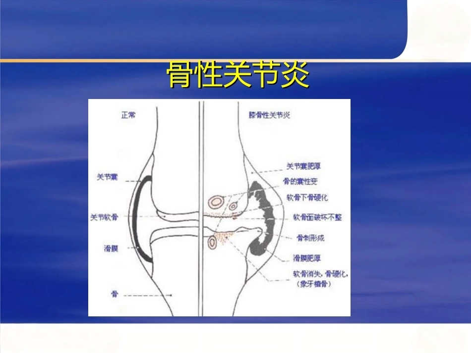 膝关节骨性关节炎的分级治疗2_第3页