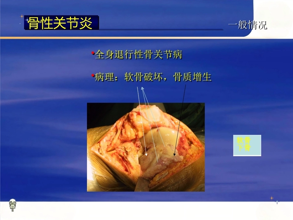 膝关节骨性关节炎的分级治疗2_第4页