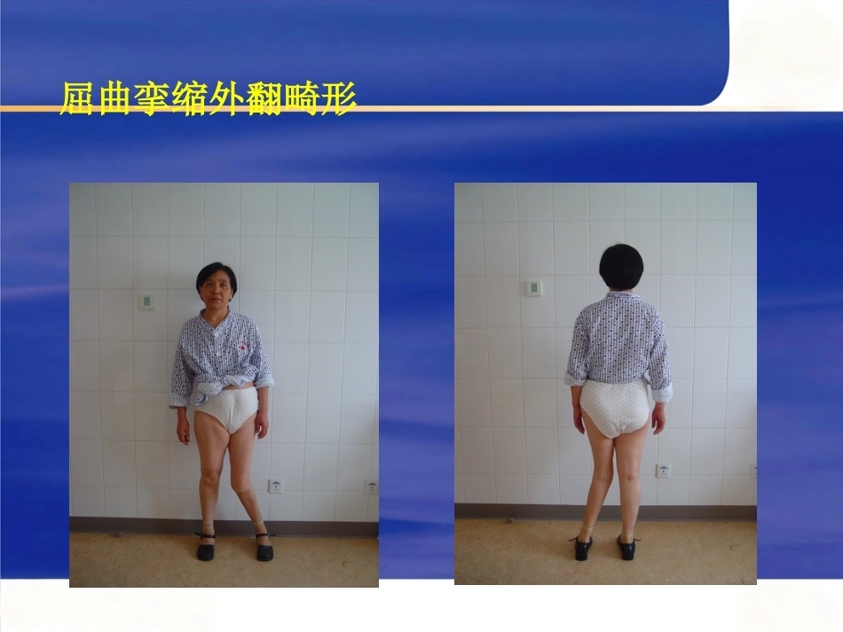 膝关节骨性关节炎的分级治疗2_第8页