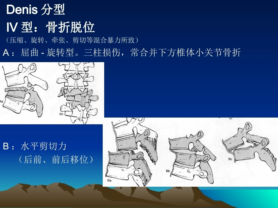 脊柱骨折常用分型及治疗原则2_第11页