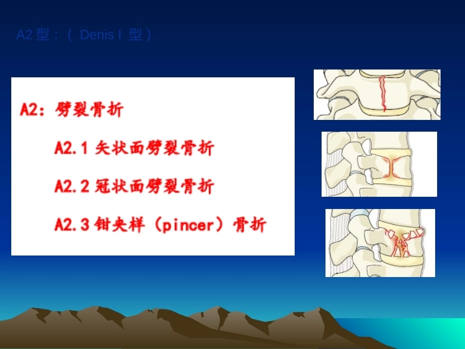 脊柱骨折常用分型及治疗原则2_第15页