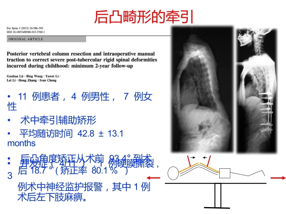 陈旧性结核后凸的手术治疗(2)_第10页