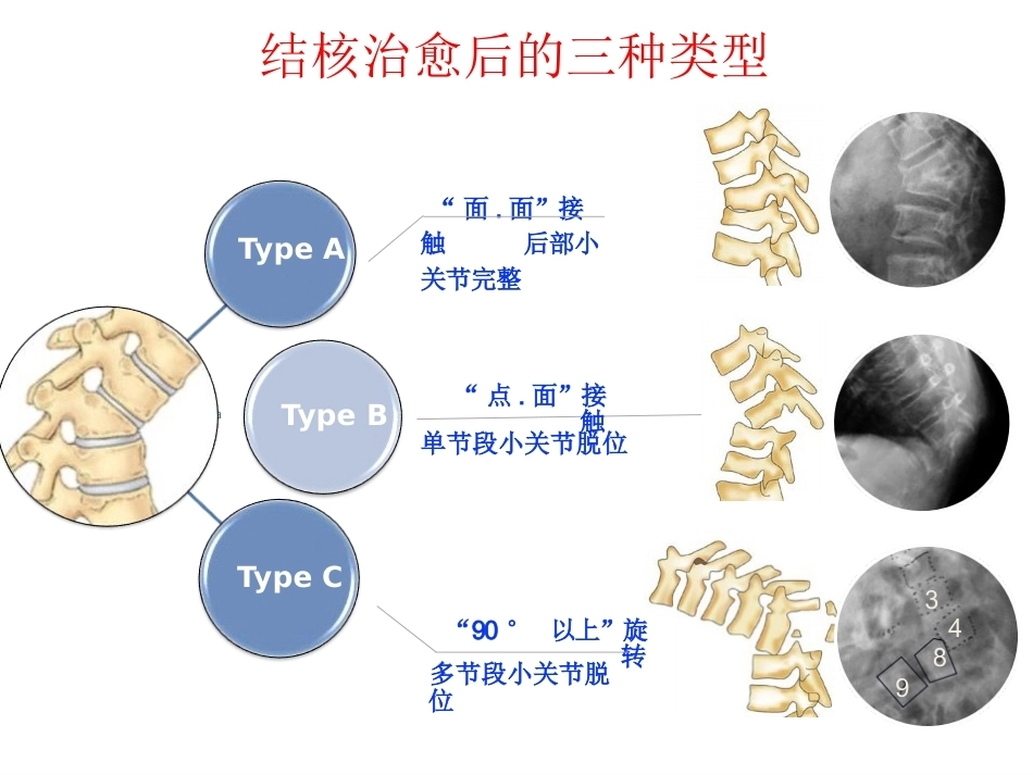 陈旧性结核后凸的手术治疗(2)_第14页