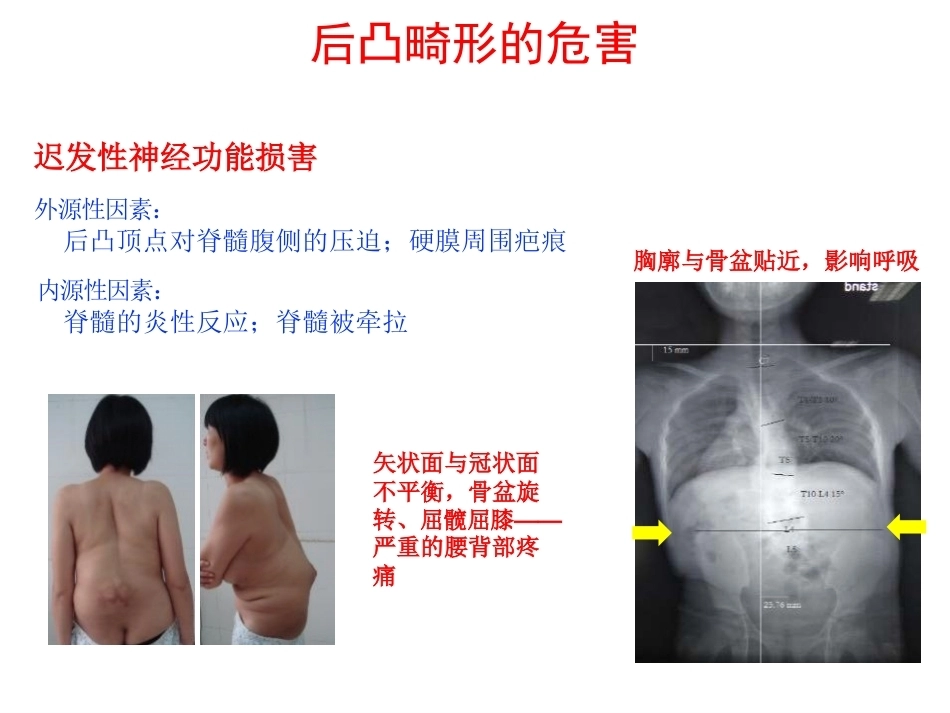 陈旧性结核后凸的手术治疗(2)_第4页