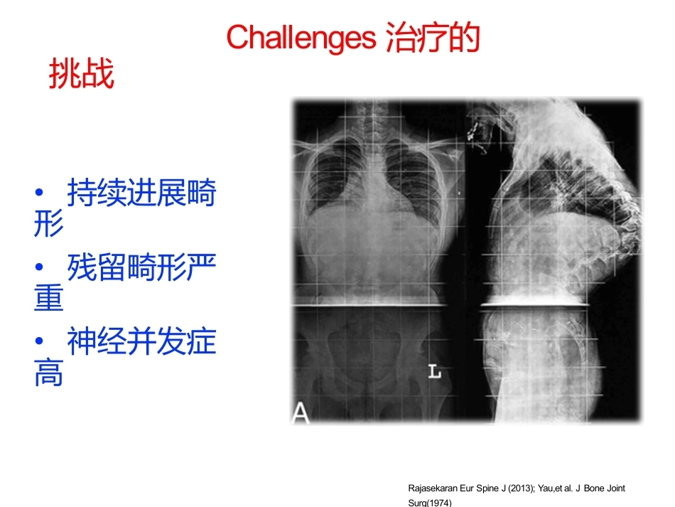 陈旧性结核后凸的手术治疗(2)_第6页