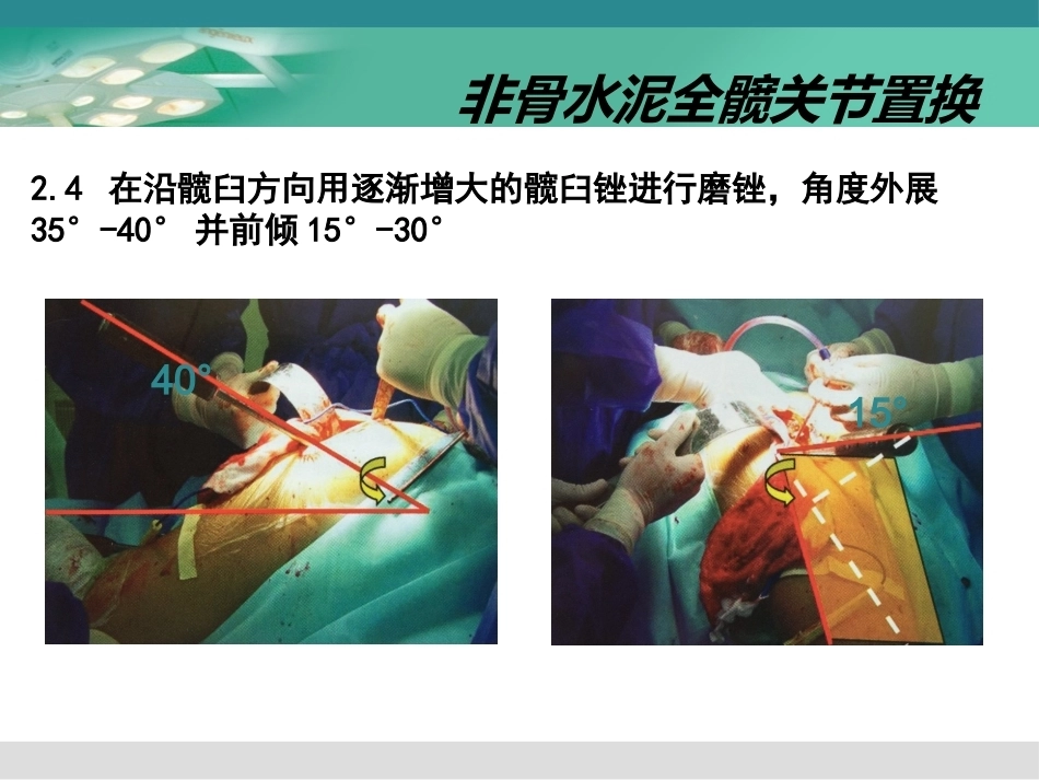 人工髋关节置换术2_第14页