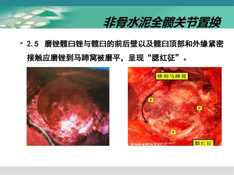 人工髋关节置换术2_第15页