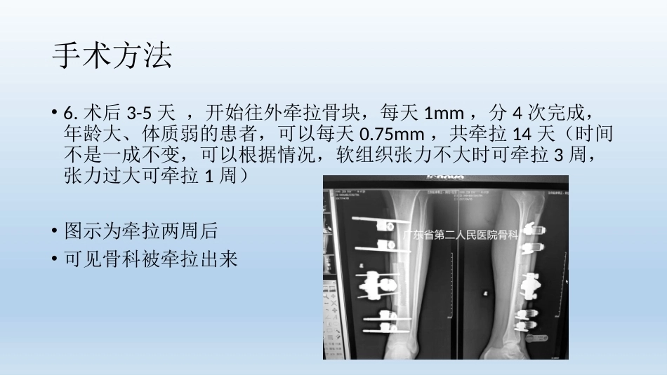 浅说胫骨横向骨搬移技术(2)_第15页